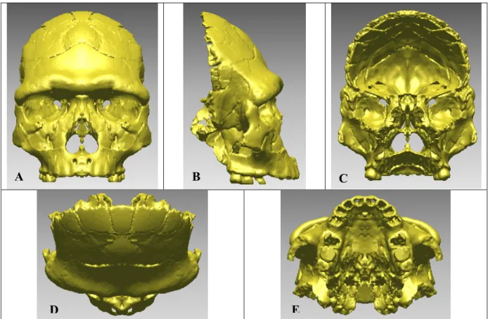 Figure 41 : Résultat de la correction de la face Arago 21. Différentes vues ; A : frontale ; B :  profil droit ; C : postérieure ; D : supérieure ; E : inférieure