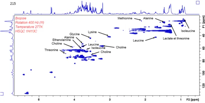 Figure 8 : spectre 2D 1H et 13C d'un échantillon de foie après hépatectomie. Le recouvrement des « tâches » le long de l’axe des abcisses expliquent la limite de quantification de certains métabolites dans certains échantillons.