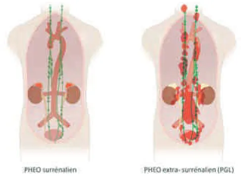 FIGURE 11. Phéochromocytomes surrénaliens et extra-surrénaliens. Une distinction est faite entre  les  PHEO  provenant  de  la médullo-surrénale (80  à 85%  des  cas)  et  les  tumeurs  provenant  du tissu  extra-surrénalien  (PGL)  (15  à  20%  des  cas),