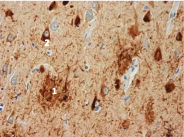 Figure 7: Représentation histologique des plaques amyloïdes extraneuronales (1) et                                             des dégénérescences neurofibrillaires intraneuronales (2) 