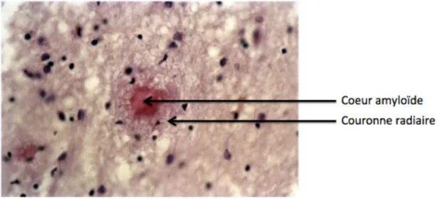 Figure 11: Représentation schématique de la distribution des plaques amyloïdes dans le parenchyme cérébral                    de patients atteints de la maladie d’Alzheimer 