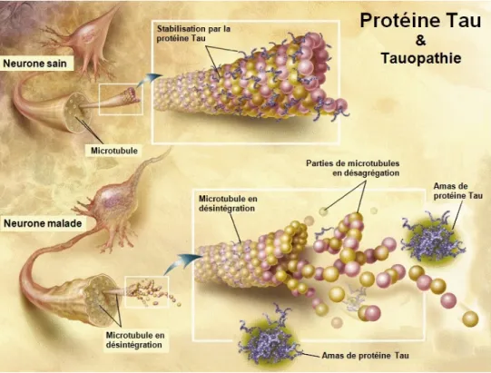 Figure 12: La protéine Tau dans un neurone sain et dans un neurone malade d’Alzheimer  (Image extraite du site internet https://fr.wikipedia.org) 