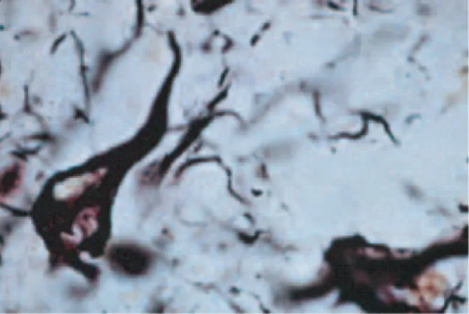 Figure 13: Image d’une dégénérescence neurofibrillaire montrant l’accumulation de fibrilles (en noir)                à l’intérieur des neurones 