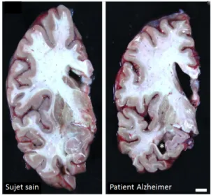 Figure 15: L’atrophie corticale et la dilatation ventriculaire dans la maladie d’Alzheimer