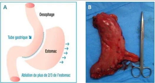 Figure 6.   Schéma illustratif de l’opération de  sleeve gastrectomie et photo de  l’estomac réséqué