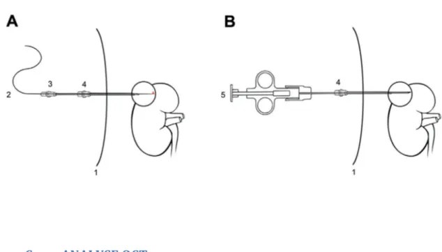 Figure 1 : Schéma de la procédure OCT (A) et biopsie (B), les repères sont la paroi abdominale (1),  la sonde OCT (2), le trocart de 18Gauge (3), l’aiguille introductrice co-axiale de 15Gauge (4) et le  pistolet à biopsie automatique (5)