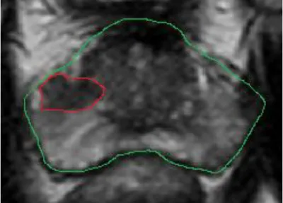 Figure I-4.  Image T2, en vert le contour de la prostate et en rouge le contour de la zone  tumorale