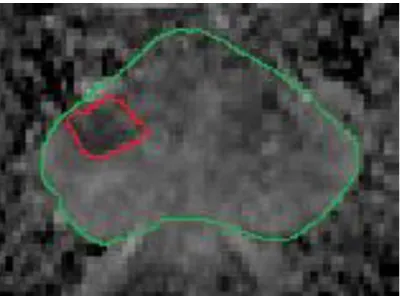 Figure I-6. Image de diffusion, en vert le contour de la prostate et en rouge le contour de la  zone tumorale