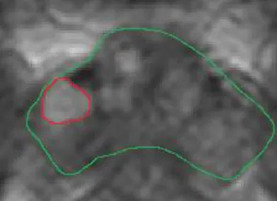 Figure I-7. Image de dynamique (DCE-MRI), en vert le contour de la prostate et en rouge le  contour de la zone tumorale