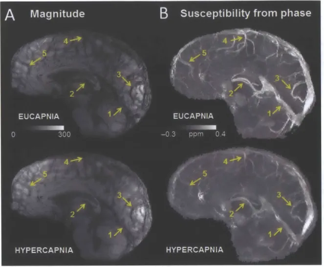 Figure 4.10.  (a)  Minimum  intensity  projection  of gradient  echo magnitude  images  and  (b)  maximum intensity projections of quantitative susceptibility maps  (ppm)  over 20-mm  corresponding  to eucapnia and  hypercapnia  in  one  volunteer