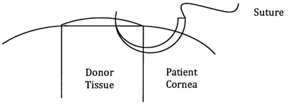 Fig. 4: Schematic  of suture use during corneal transplant