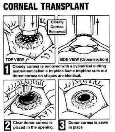 Fig 3a:  Illustrative  procedure  of corneal transplant  [7].