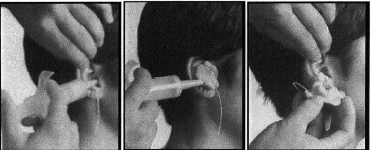 Figure 1.5:  The injection of impression material into an ear, and the removal  of the impression.