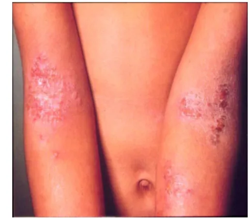 Figure 6 : Prévalence mondiale des symptômes de la dermatite atopique chez les  enfants (ISAAC, 1998) 