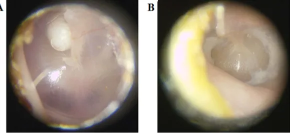 Figure  1 shows representative white light images of a cholesteatoma and a myringosclerosis lesion in  situ before surgical excision