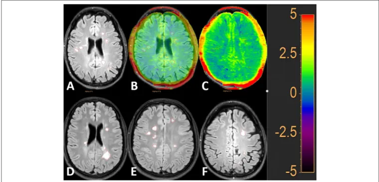 FIGURE 2 | FLAIR image with 50% and 100% APTw image overlay. MS lesions (MSL) are outlined in red