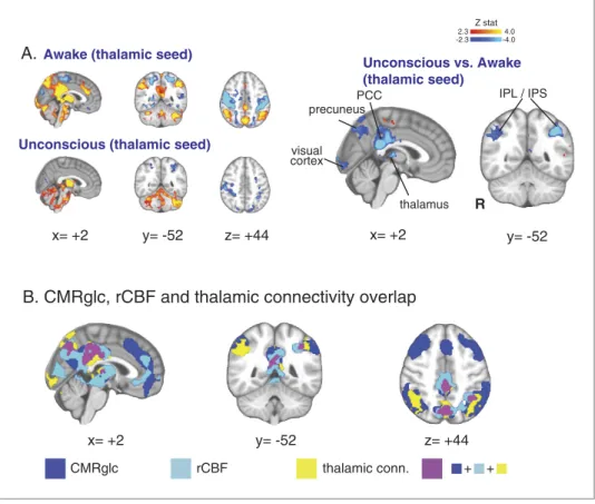 Figure 4. Seed based functional connectivity analysis of the brain region with overlapping changes in CMR glc , rCBF,  and functional connectivity