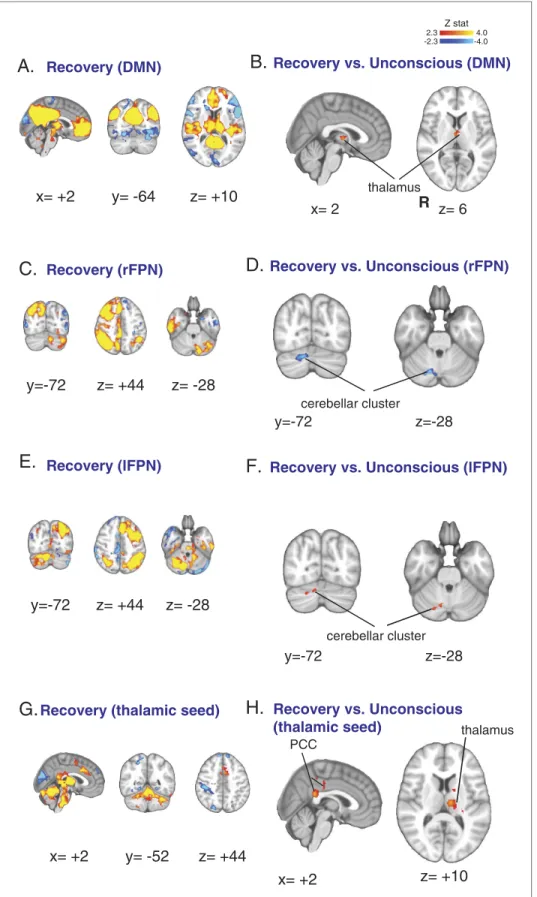 Figure 6. Functional connectivity changes observed during recovery of consciousness. (A) The DMN extracted  from BOLD signals obtained during the recovery state (n = 15) displayed on the MNI152 standard volume