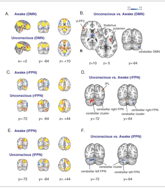 Figure 3. Changes in the default mode and the bilateral frontal parietal networks during unconsciousness
