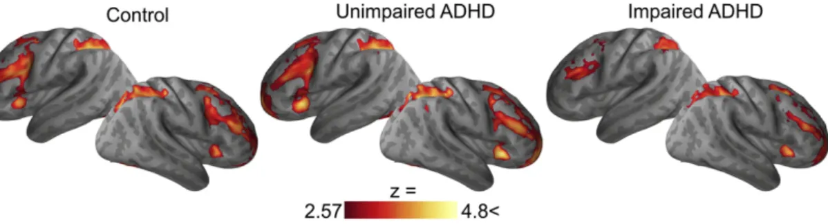 Fig. 3. (A) The Control group exhibited signiﬁcantly greater linear increases in activation across working memory loads than the Impaired ADHD group in left inferior frontal junction, precuneus, supracalcarine cortex, lingual gyrus, and cerebellum