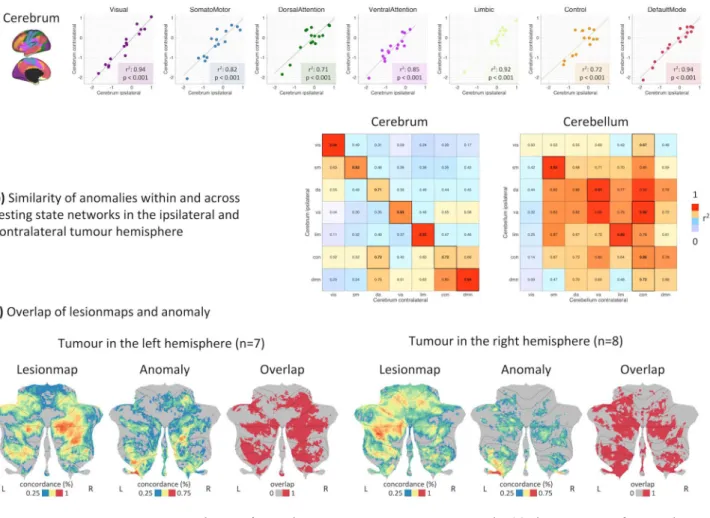 Figure 3.  Distribution of anomaly scores in seven resting-state networks. (a) The patient-specific anomaly  scores showed a symmetry within cerebral resting-state networks in the ipsilateral and contralateral tumour  hemispheres