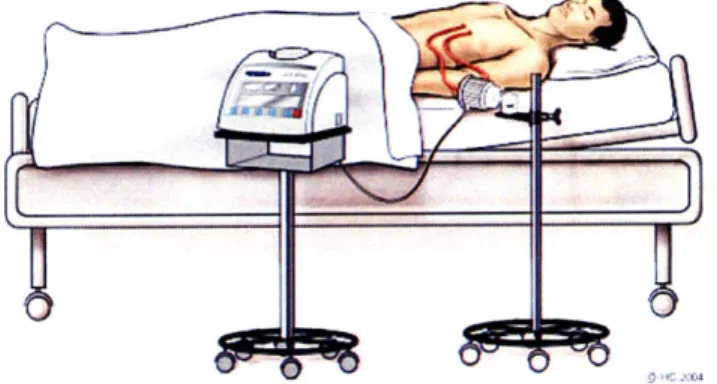 Figure 8 [22]. CM placed extracorporeally. The CM is a centrifugal-type rotary blood pump that is placed outside the body.