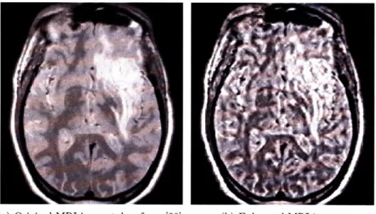 Figure  4-4:  Enhancement  result  of  an  MRI  image.