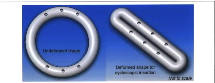 Figure  1.  A  loop-shaped  device  with  multiple  drug  release  orifices.  Undeformed  shape  of  the  device  after being  deployed  in  the  bladder (left)