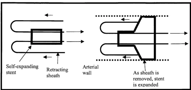 Figure 4 A  self-expanding stent being deployed. The  left  figure shows  the  sheath  that covers  the  stent  being  retracted