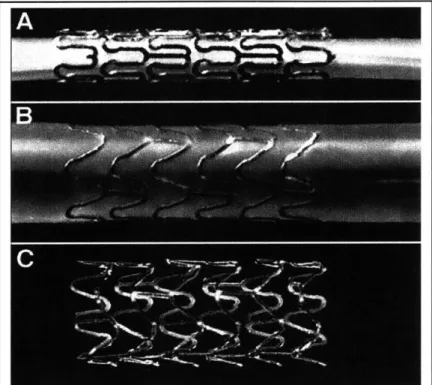 Figure  1.2:  A  stainless  steel  stent  mounted  upon  a  balloon catheter  (A)  before  and  (B)  after balloon  inflation,  and  (C)  after balloon withdrawal.