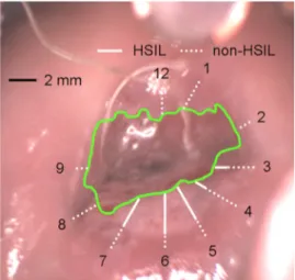Fig. 1 High-grade squamous intraepithelial lesion (HSIL) and non-HSIL (low-grade SIL and benign) regions overlaid on a white-light photograph of the cervix