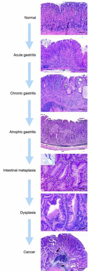 Figure  1.3.  Histological  progression  of  Helicobacter-induced  gastric cancer in mouse model