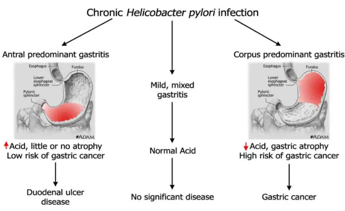Figure 1.4. Divergent responses to H. pylori infection lead to three major clinical outcomes