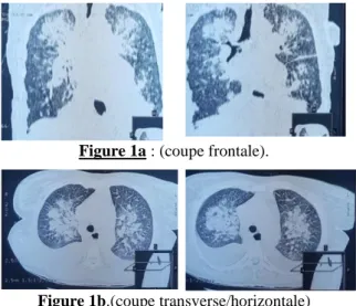 Figure 1b.(coupe transverse/horizontale)  Figure  1 :  Imagerie  démontrant  la  pneumopathie  interstitielle  due  à  la  COVID-19  entraînant  un  SDRA chez un des patients mauritaniens hospitalisé  à Kiffa