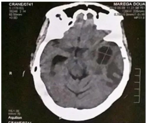Figure 1 : abcès cérébral gauche à la TDM 