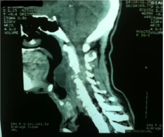 Figure 1 : Tomodensitométrie cervicale, Abcès épidural compressif. 