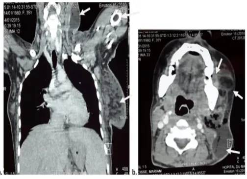 Fig 3 : TDM cervico-thoracique.  a : nécrose et  un abcès des espaces celluleux  de la joue, du cou et de la glande mammaire gauche ;  b : abcès cervico-faciale  en rapport avec le foyer d’infection dentaire 