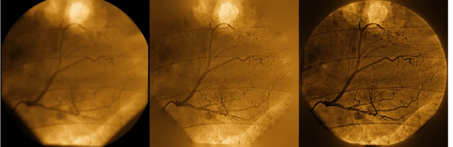 Fig. 1: Blind and myopic deconvolution of a single coronarographic image. Left: original image