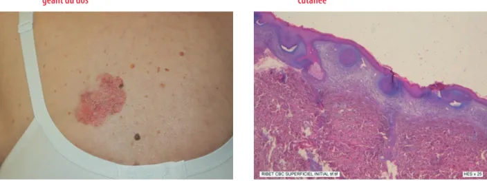 FIGURE 1.  Aspect macroscopique du carcinome basocellulaire 