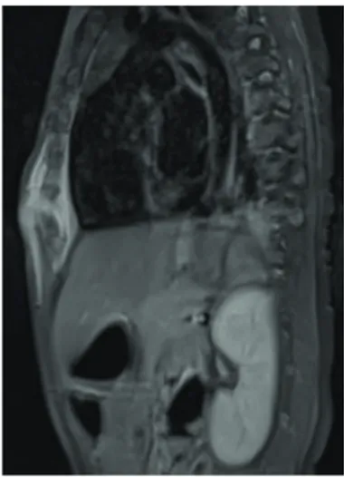 FIGURE 2. Ostéomyélite abcédée de l’appendice xiphoïde  visualisée sur l’IRM en coupe sagittale.