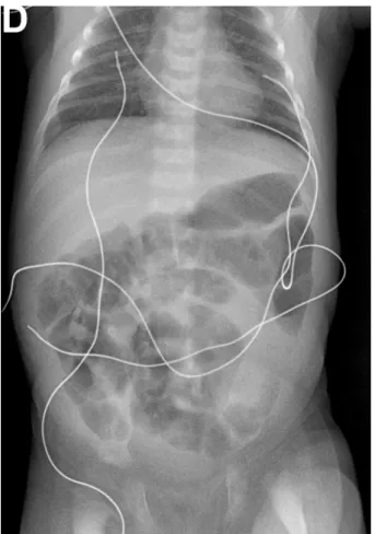 FIGURE 1.  Radiographie thoraco-abdominale