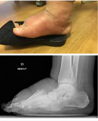 TABLEAU 2. Caractéristiques des neuroarthropathies