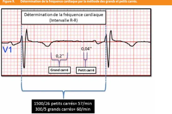 Figure 9.  détermination de la fréquence cardiaque par la méthode des grands et petits carrés.