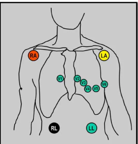 Figure 4.  disposition des électrodes périphériques, et précordiales. rA : épaule droite,  lA : épaule gauche, rl jambe droite, ll : jambe gauche 