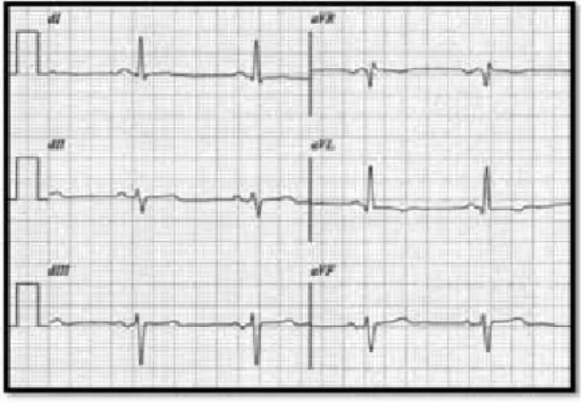 tableau 2.  Mesure rapide de l’orientation électrique  du cœur. + correspond à un complexe Qrs  positif, - un complexe Qrs négatif.
