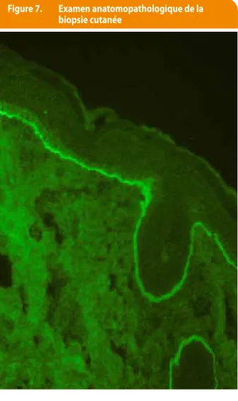 Figure 7.  examen anatomopathologique de la  biopsie cutanée
