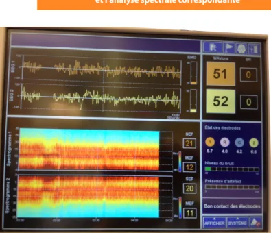 Figure 1 :  Exemple de monitoring cérébral 