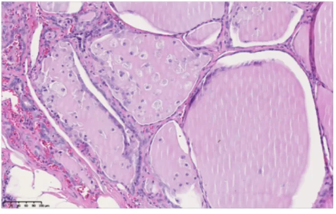 Figure 3 :   Coupe d’un lobe thyroïdien (grossissement  x20) chez le patient n°2