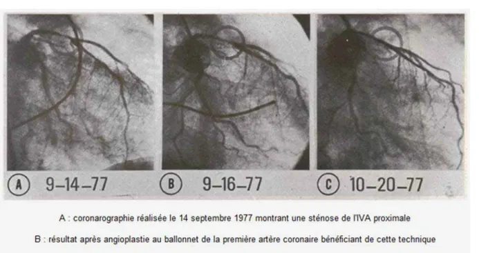 Figure 3 :  Images illustrant la première dilatation coronaire réalisée par A. Grüntzig en septembre 1977