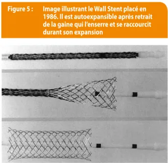 Figure 5 :  Image illustrant le Wall stent placé en  1986. Il est autoexpansible après retrait  de la gaine qui l’enserre et se raccourcit  durant son expansion
